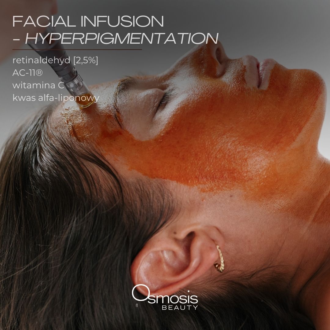 Facial Infusion - Hyperpigmentation